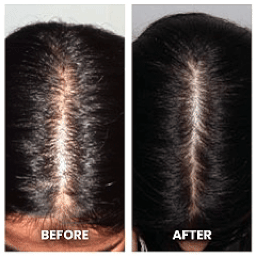 Enhanced Hair Regrowth Laser Cap