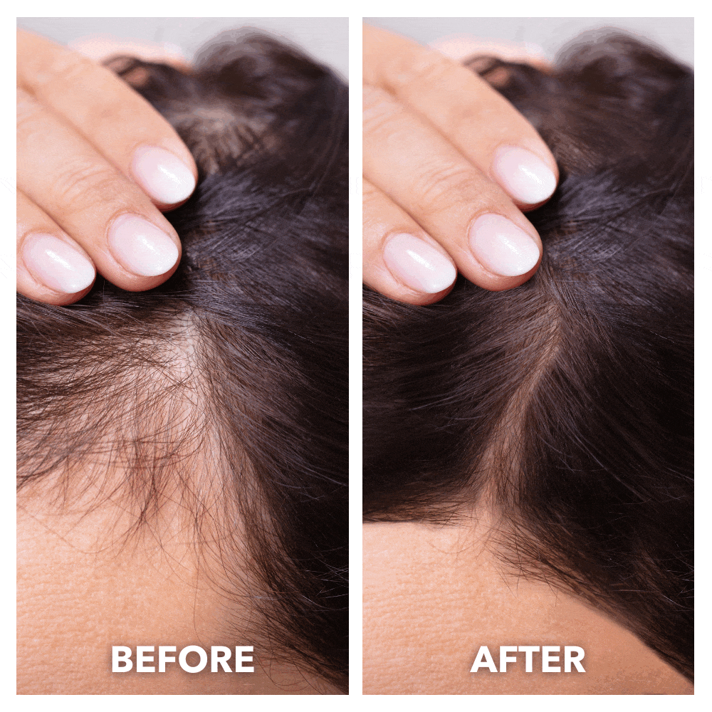 Enhanced Hair Regrowth Laser Cap