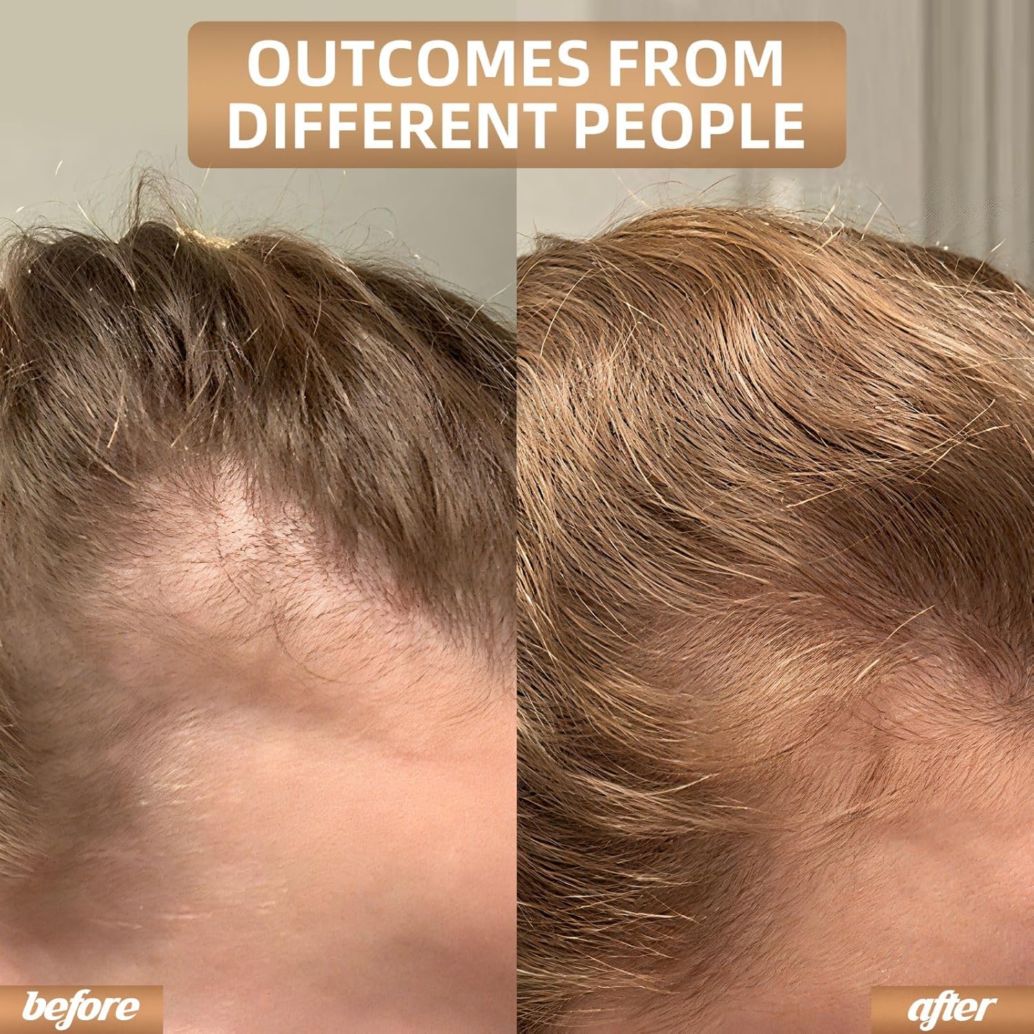 Enhanced Hair Regrowth Laser Cap