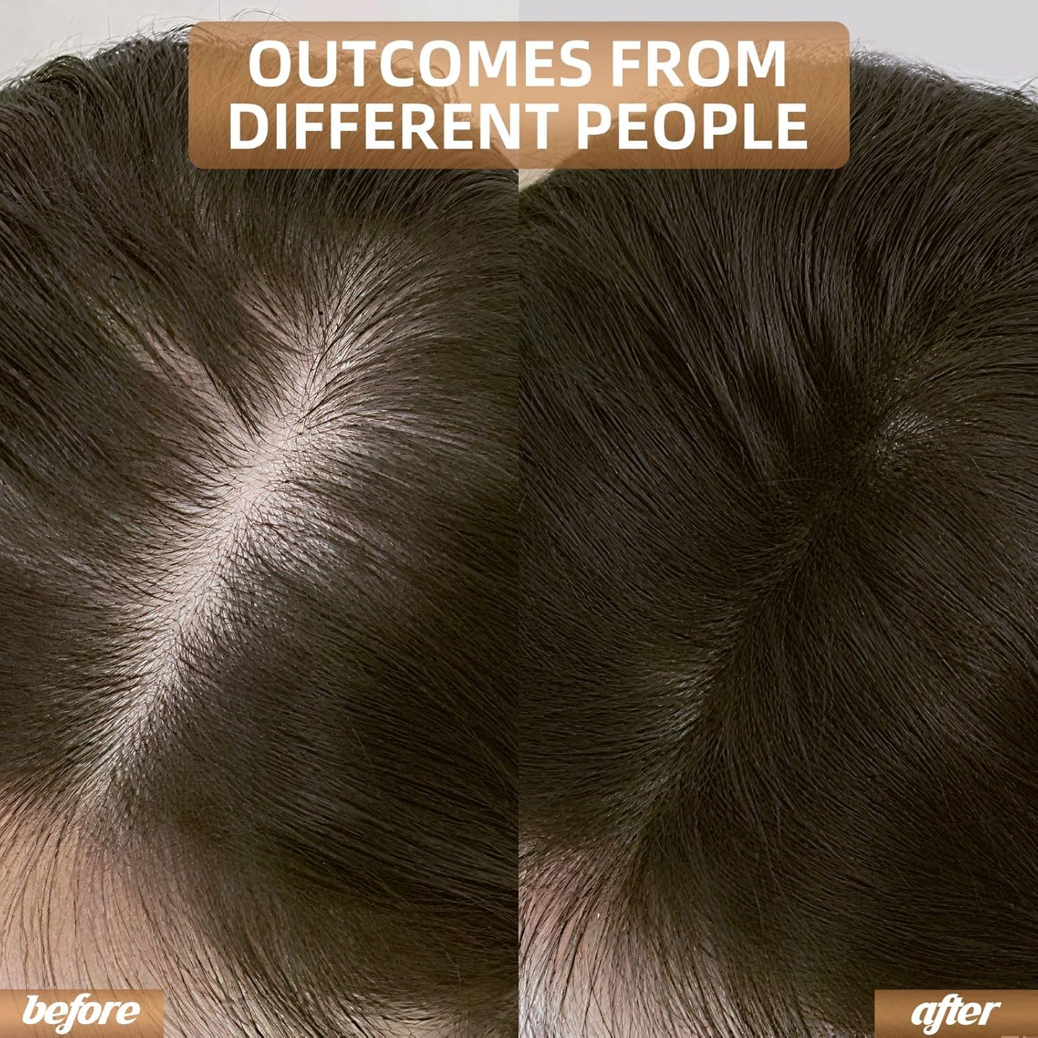 Enhanced Hair Regrowth Laser Cap